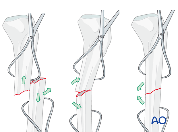 Pointed reduction forceps may also be used to grasp and manipulate fracture fragments as shown here.