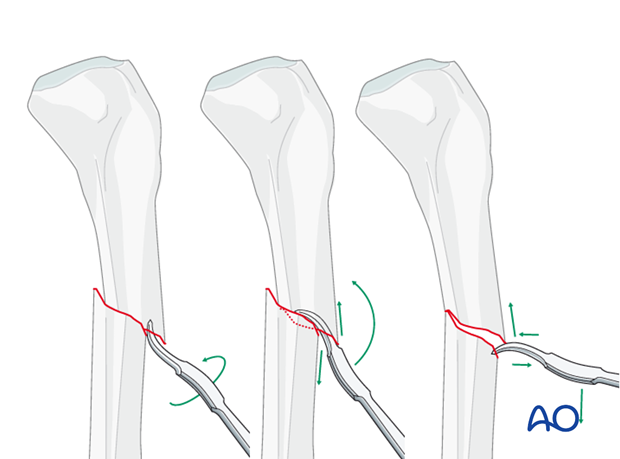 Transverse fractures