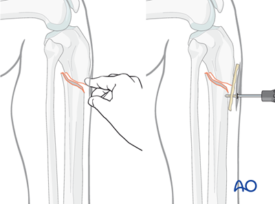 Intramedullary nailing for Simple fracture, oblique