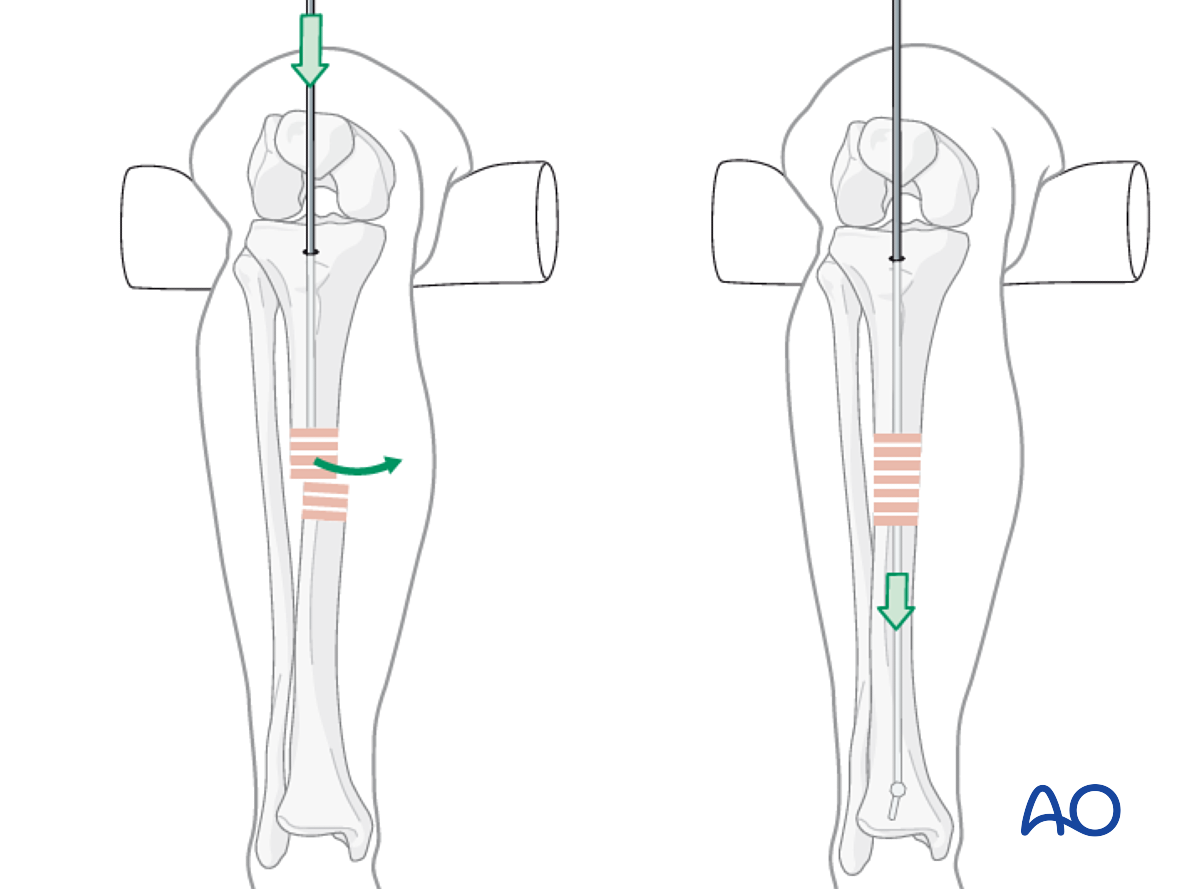 PDF] Comparison of suprapatellar and infrapatellar tibial nailing : more  anatomic entry point and fracture reduction via the suprapatellar approach  | Semantic Scholar