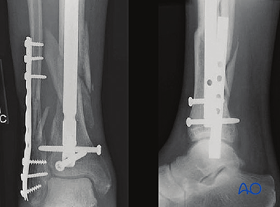 Intramedullary nailing for Simple fracture, oblique