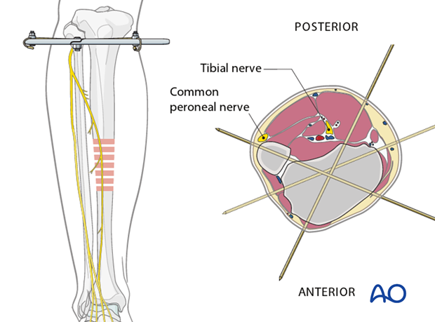 Fixation of ring fixator to proximal tibia. (a) Transverse wire