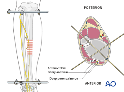 Ring fixator (Ilizarov) for Simple fracture, oblique