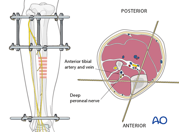 Fixation of ring fixator to proximal tibia. (a) Transverse wire