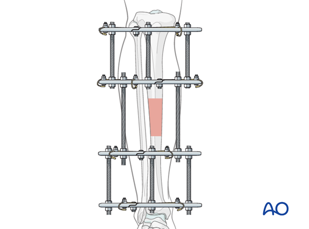 Full ring external fixation (Ilizarov) for Extraarticular, wedge fracture