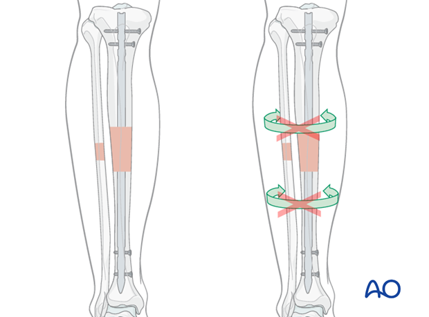 Intramedullary (IM) nailing is the first treatment choice for most tibial shaft fractures.