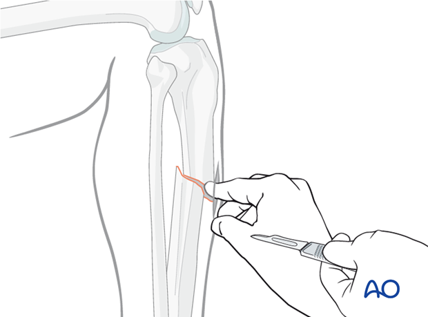 Incision for open reduction