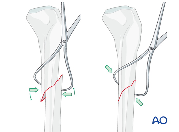 Reduction with bone clamp