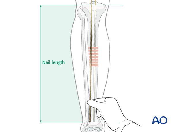 Determining nail length