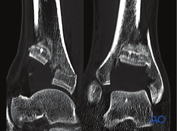 Distal Tibia Plate Surgical Technique