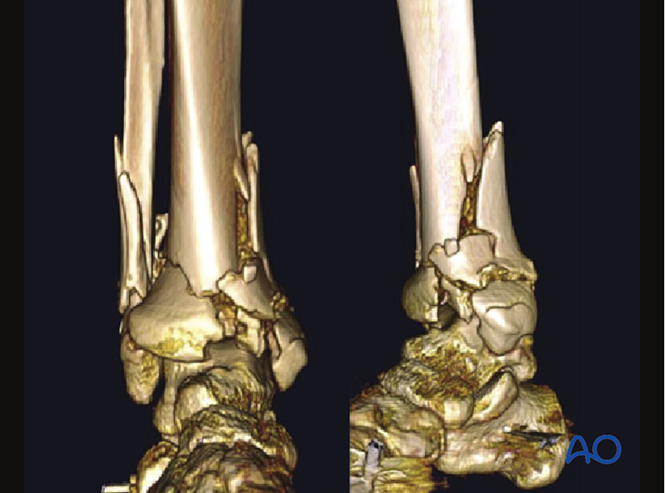 Anteromedial approach to the distal tibia