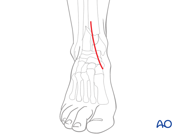 anteromedial approach to the distal tibia