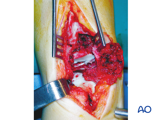 anteromedial approach to the distal tibia