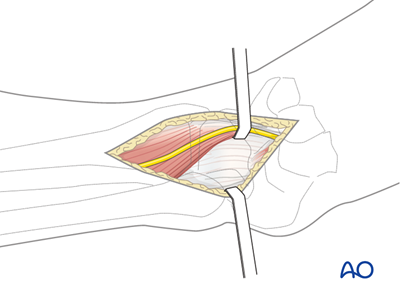 ORIF - Plate and screws through anterolateral approach for Complete ...