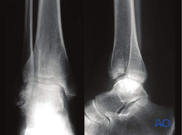 anterolateral approach to the distal tibia