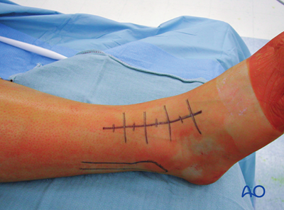 Anterolateral approach to the distal tibia