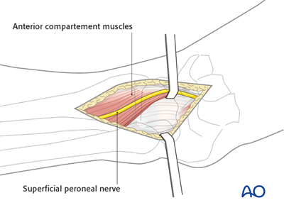 Anterolateral approach to the distal tibia