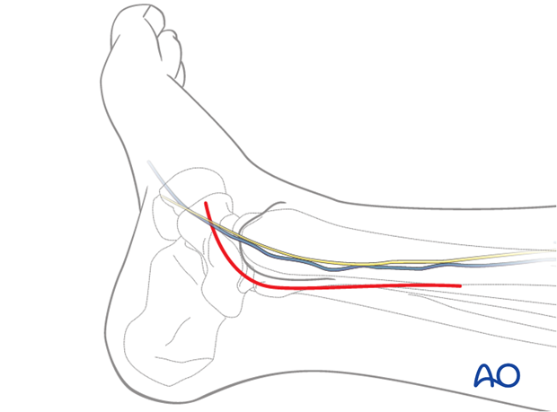 posteromedial approach to the distal tibia
