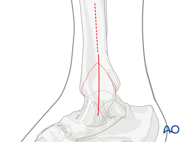 Distal Tibia Plate Surgical Technique