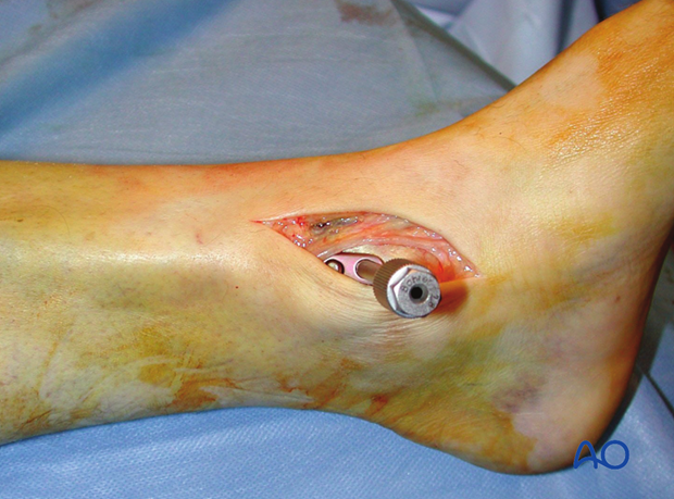 minimally invasive approach to the distal tibia