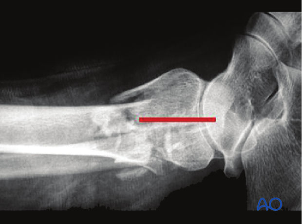 minimally invasive approach to the distal tibia