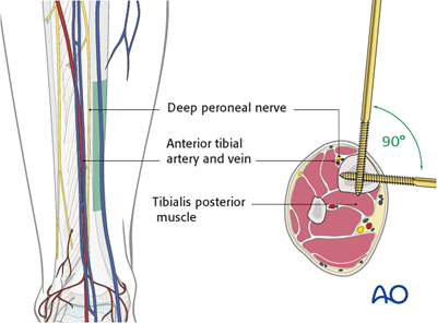 Safe zones in the tibia