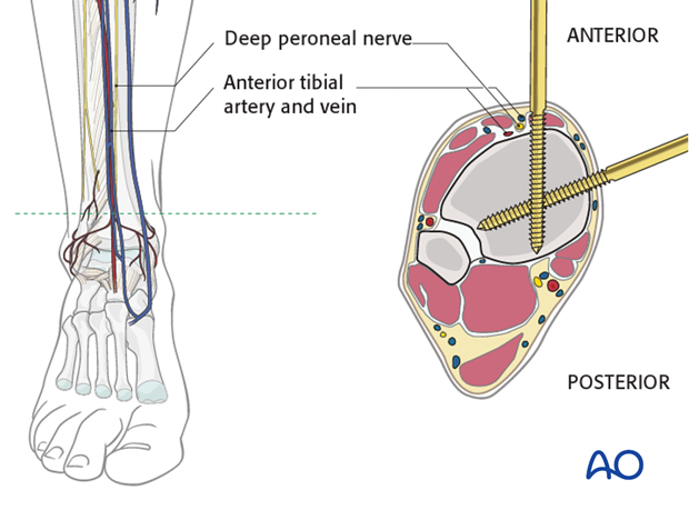 Tibial Pursuit: How to identify and side the tibia