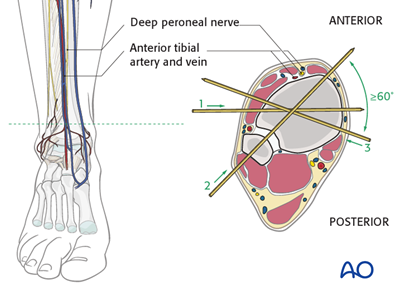 Safe zones in the tibia