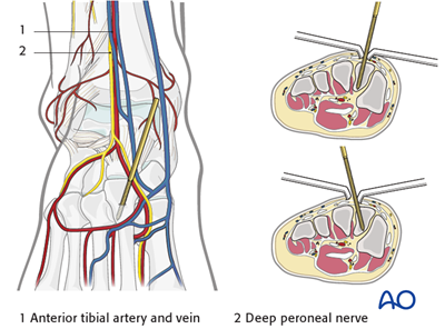 Safe zones in the tibia