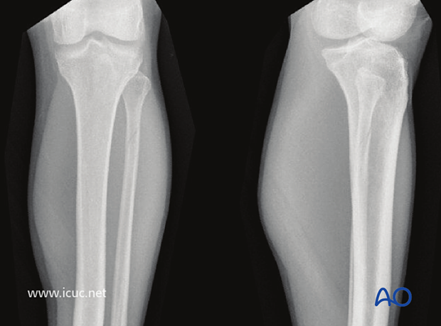 Preoperative AP and lateral X-rays show a Maisonneuve fracture of the proximal fibula in a 25-year-old.