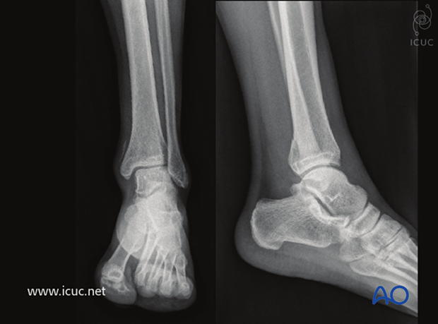 Preoperative AP and lateral X-rays show the posteromedial injury to the distal tibia.