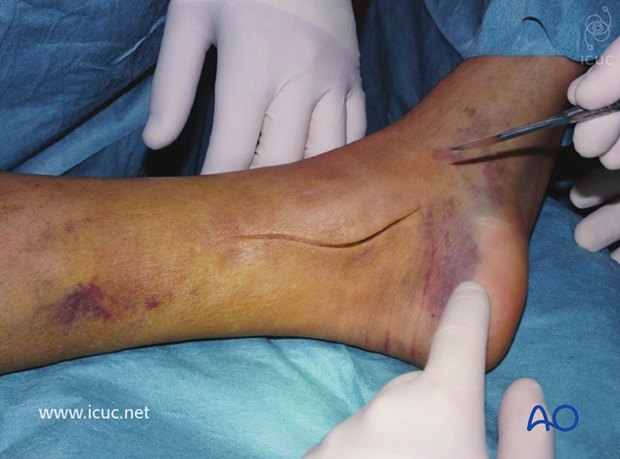 The distal tibia was accessed through a medial incision.