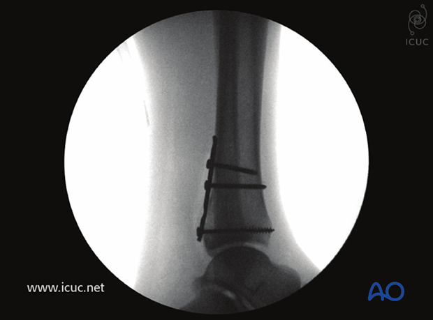 Final lateral image after insertion of distal screw