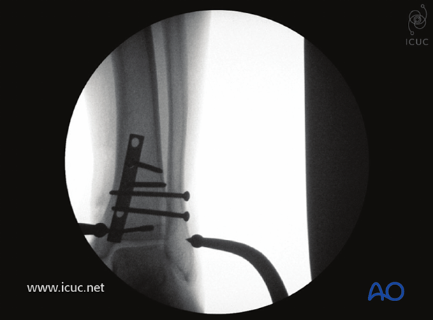 Intraoperative AP X-ray showing fracture reduction