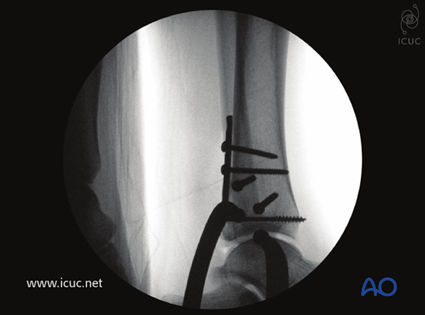 Intraoperative lateral X-ray showing fracture reduction