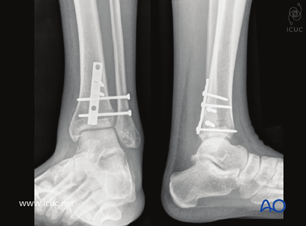 6 weeks postoperative AP and lateral view showing a stable ankle ready for weight bearing