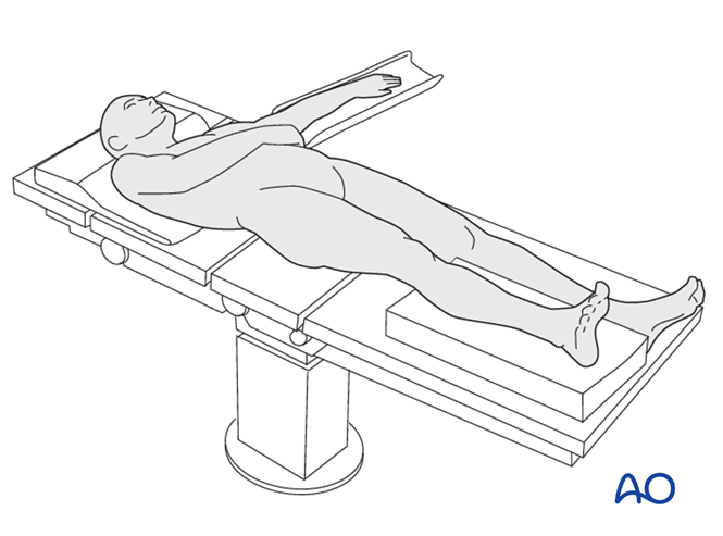 Nonoperative treatment - Temporary cast for Extraarticular, wedge fracture