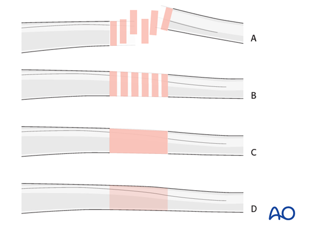 Generic fracture pattern in a long bone