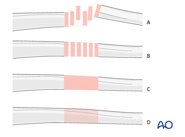 Full ring external fixation (Ilizarov) for Extraarticular, wedge fracture