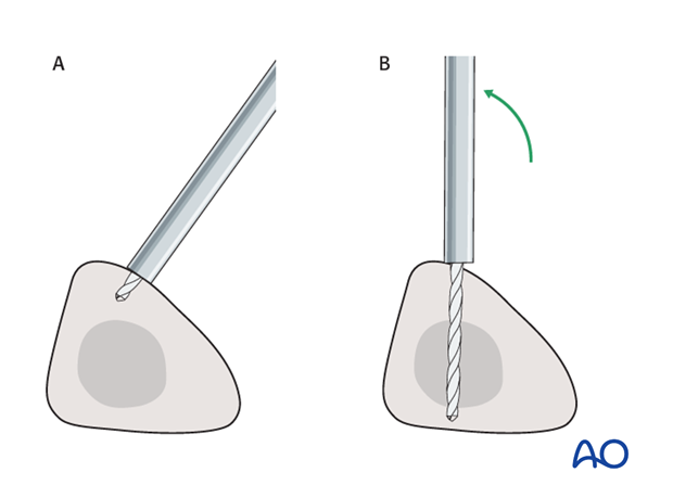 Alternative tibial pin placement for modular external fixation