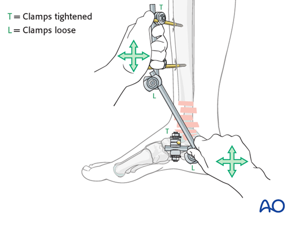 Distal tibia fracture reduction with modular external fixation