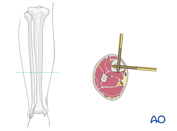 Full ring external fixation (Ilizarov) for Extraarticular, wedge