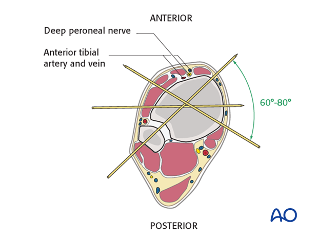 Wires and pins safe positioning in the distal tibia