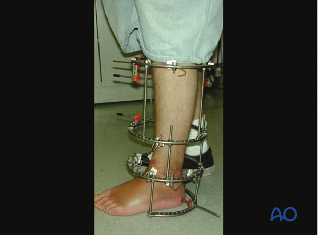 Full-ring Ilizarov frame applied for lengthening of tibia.