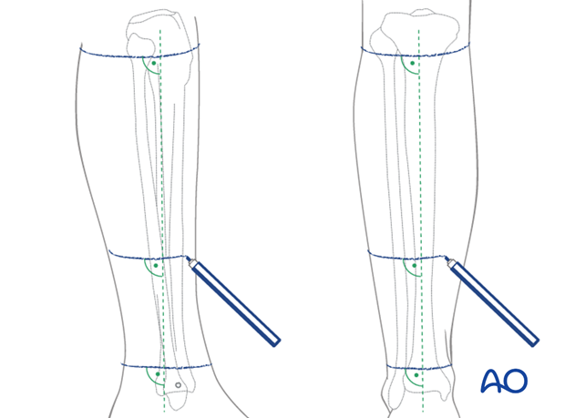 Four ring frame designing with spread along entire length of tibia