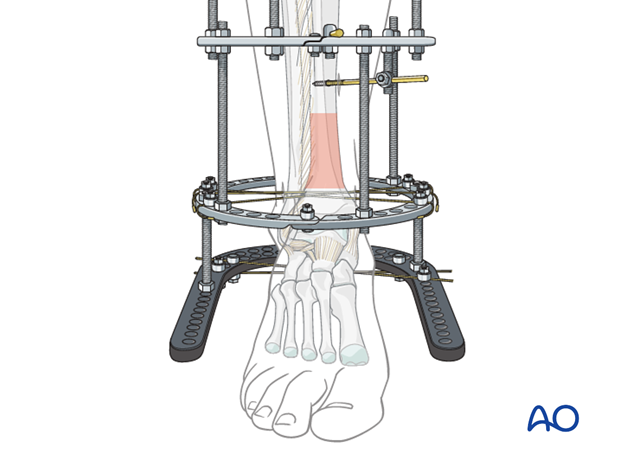 Llizarov Tibia Ring External Fixator Lengthening for Delayed