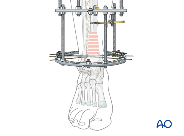 Reduction with full ring external fixation to treat a distal tibia fracture