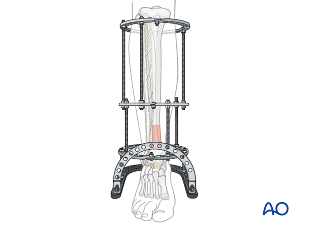 Tibia Ring Ilizarov External Fixation for Clubfoot Treatment - China  External Fixator, Ilizarov External Fixator