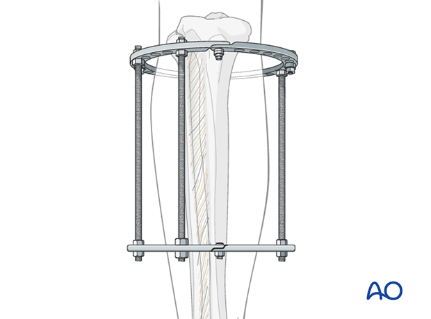 Frame preparation for full ring external fixation