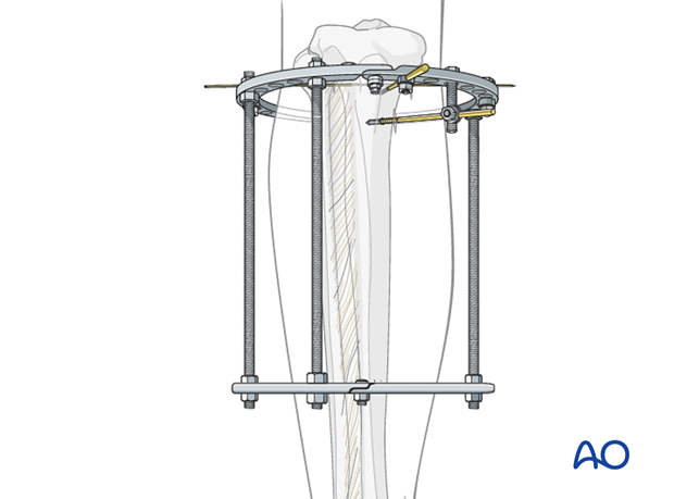 Full ring external fixation (Ilizarov) for Extraarticular, wedge fracture